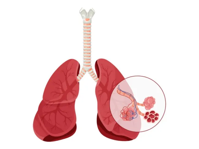 Edem pulmonar: o urgență medicală ce se manifestă prin dispnee