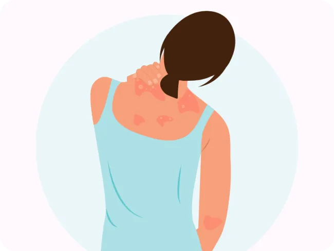 Psoriazis: o boală invalidantă social